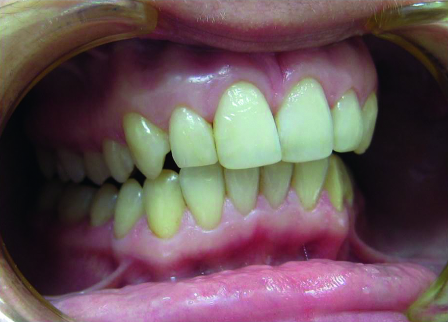 prowadzenie klowe Szyna Sved Open Dental Lab Szynoterapia - Dent Plus Stomatologia